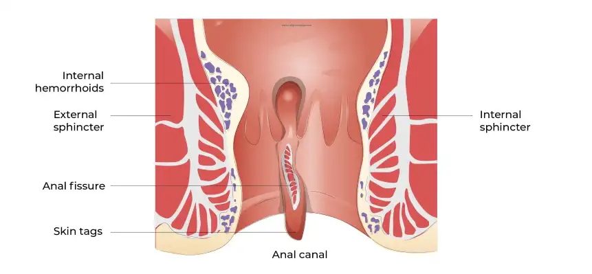 Laser Fissure Treatment