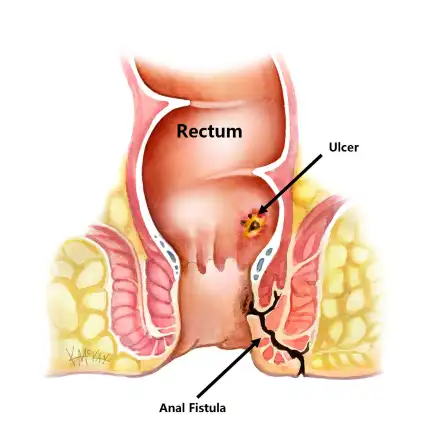 Laser Fistula Treatment