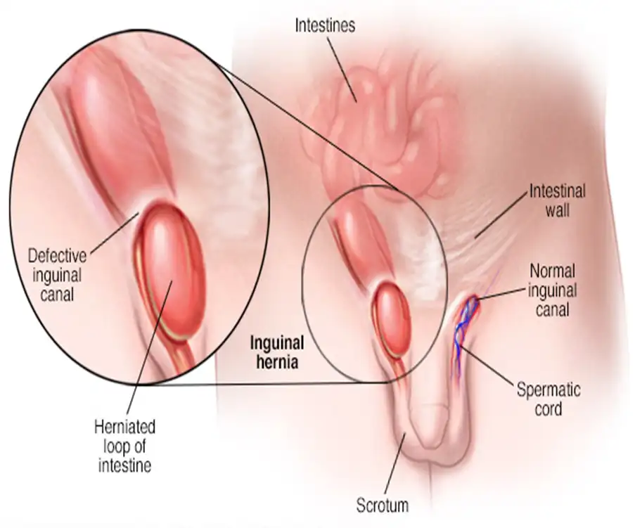 Groin Hernia