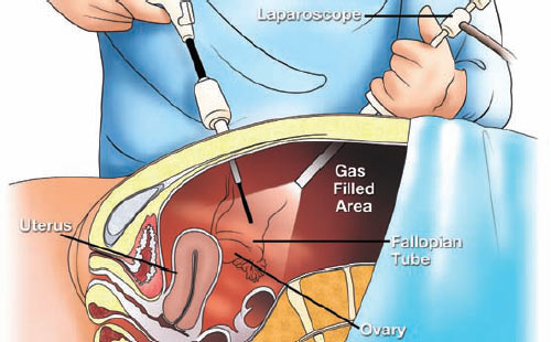 Gynecologic Laparoscopy