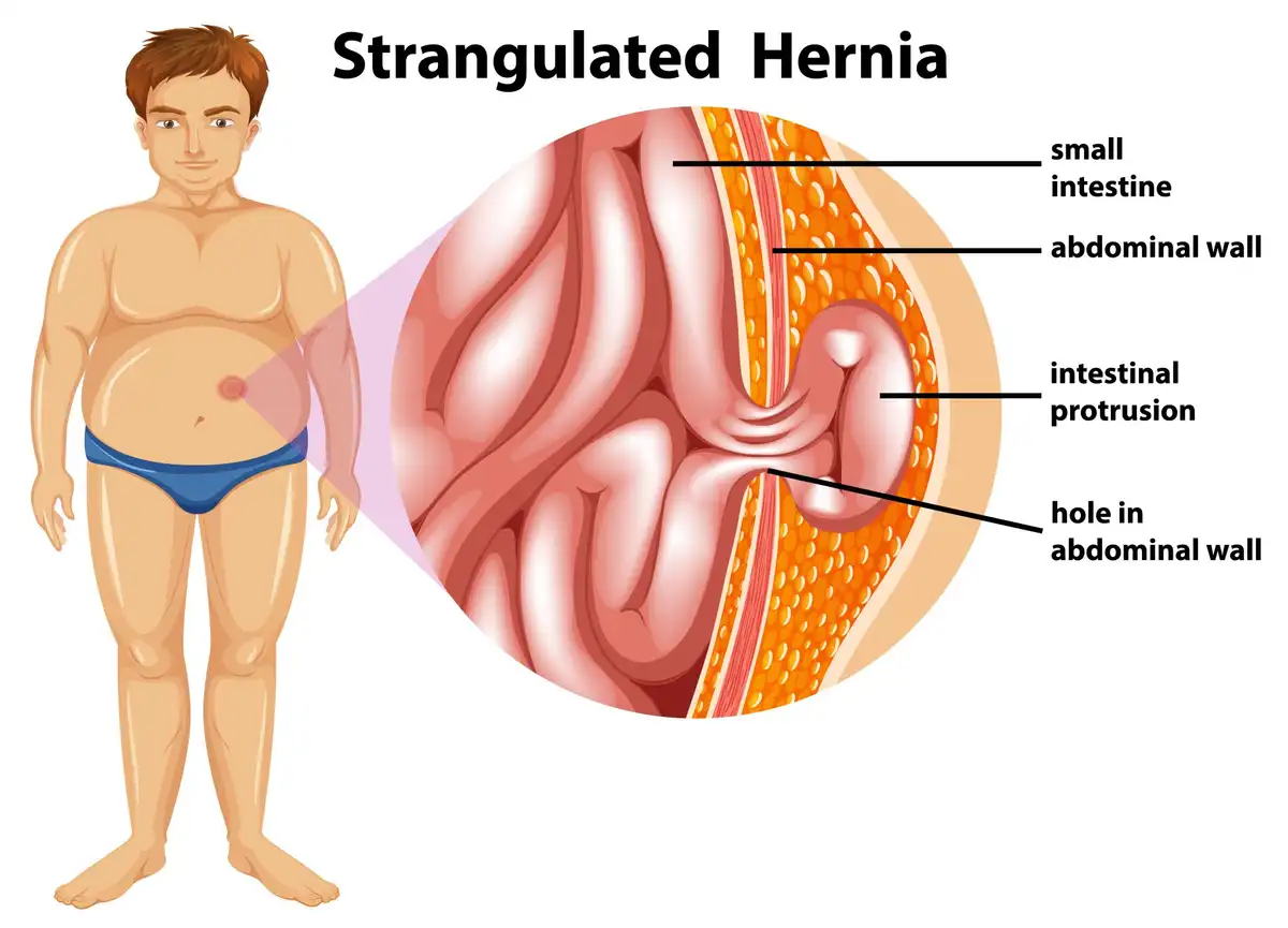 Hernia Surgery
