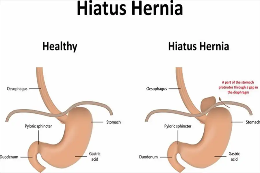 Hiatus Hernia