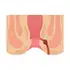 Fistula & Fissures Surgery