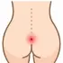 Laser Pilonidal Sinus Treatment