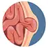 Umbilical Hernia