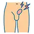 Ventral Hernia