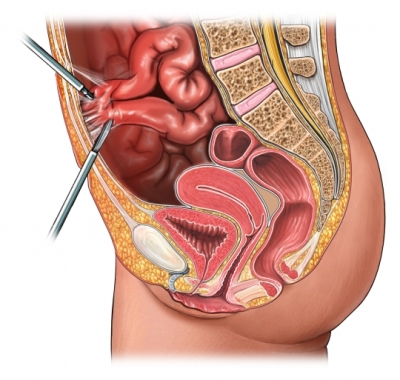 Laparoscopic Adhesiolysis