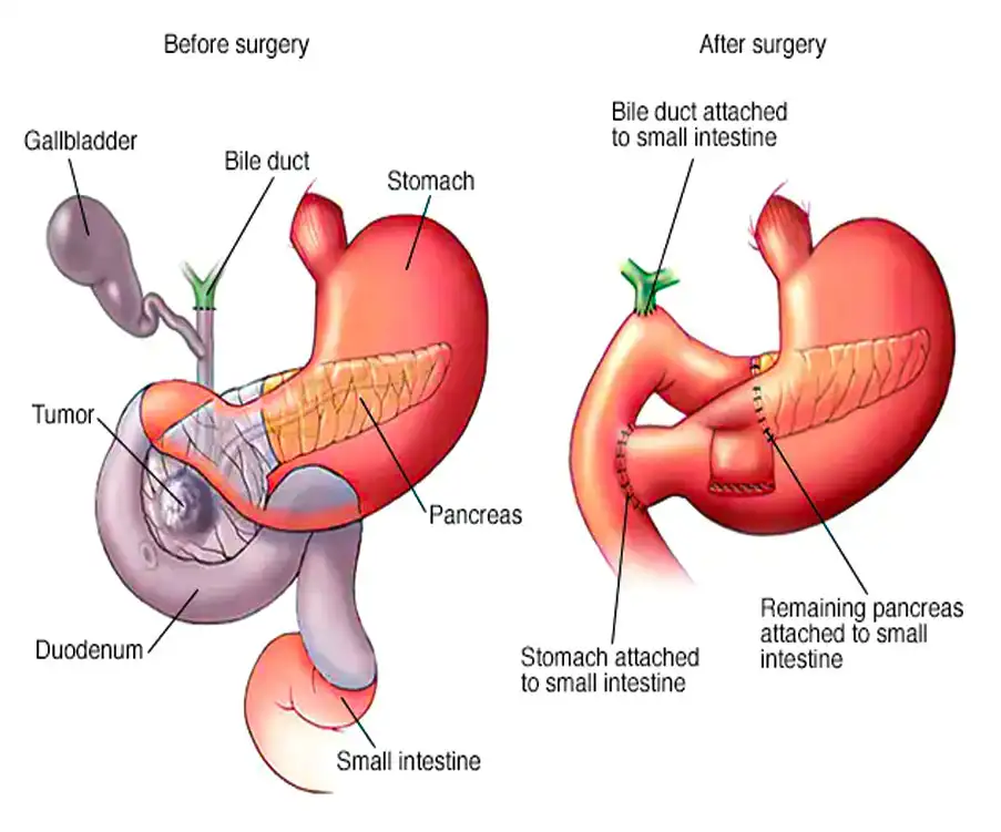 Pancreas Surgery