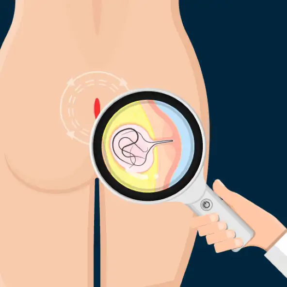 Laser Pilonidal Sinus Treatment