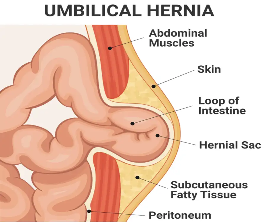 Umbilical Hernia