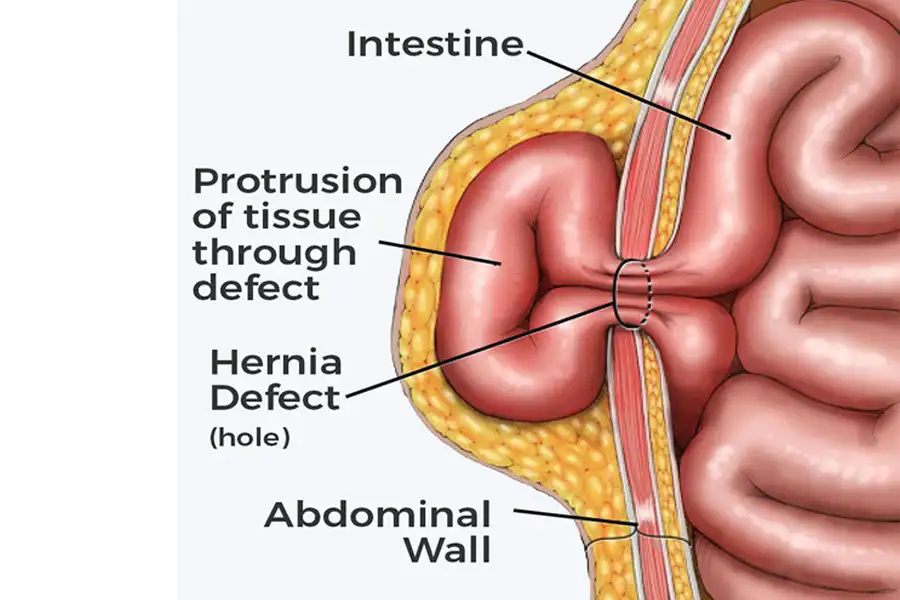 Ventral Hernia